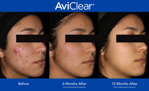 AviClear 3 Month Results